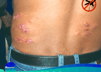 Detectados 37 casos de Leishmaniasis en la Parroquia Teresén, Municipio Caripe